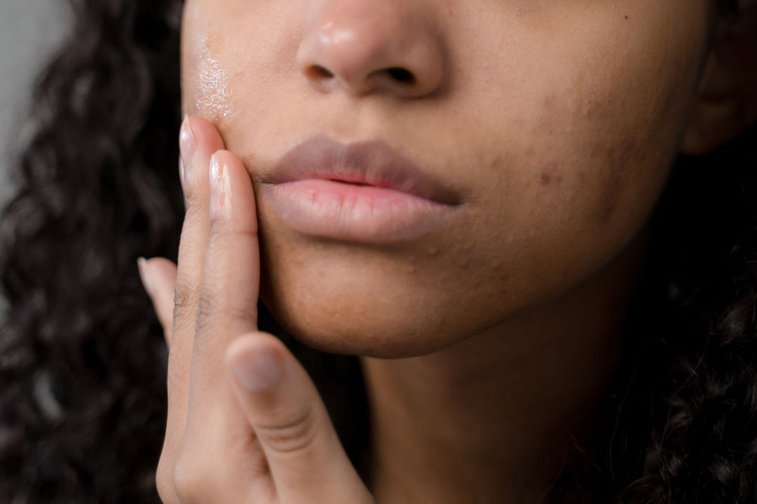 PCOS: When it's More Than Just Bad Acne