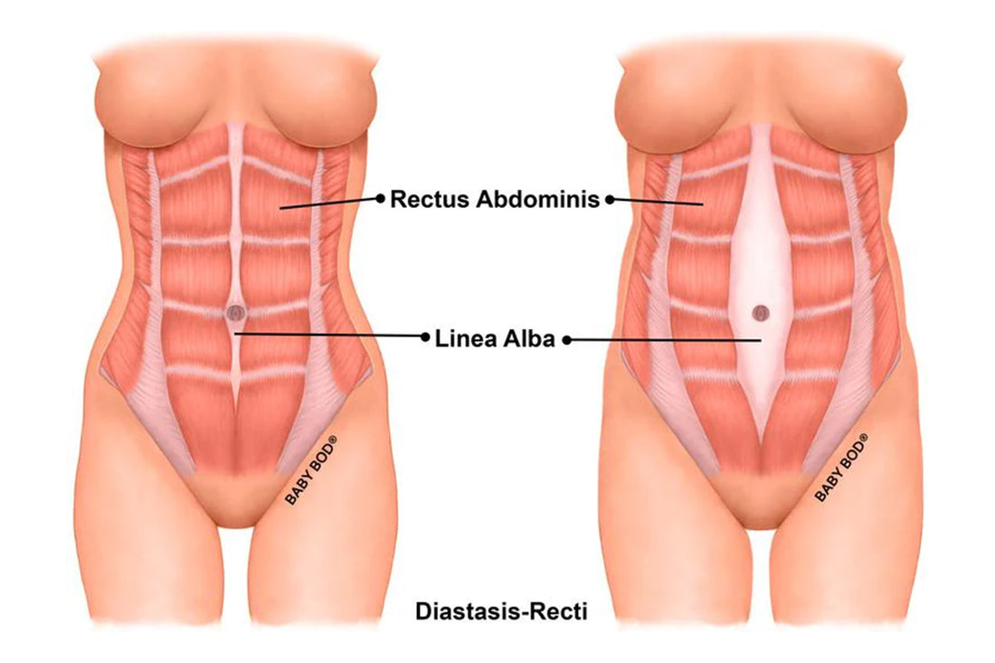 The Mommy Tummy  Understanding Diastasis Recti
