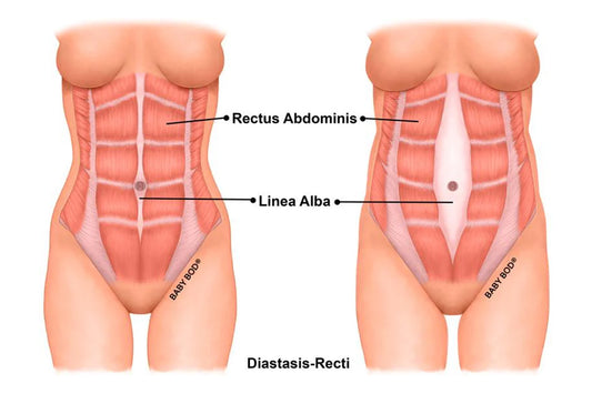 Diastasis Recti: How To Know If You Have It